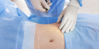 Liposuzione Rimodellamento Corpo Roma Liposuzione Rimodellamento Corpo Roma