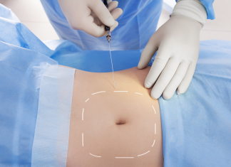 Liposuzione Rimodellamento Corpo Roma Liposuzione Rimodellamento Corpo Roma