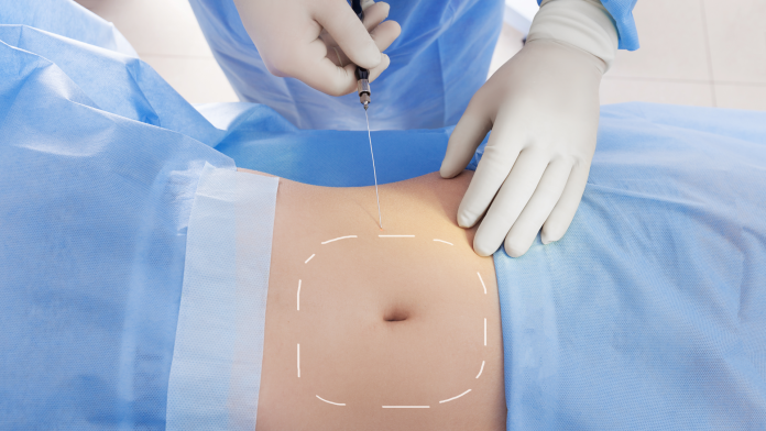 Liposuzione Rimodellamento Corpo Roma